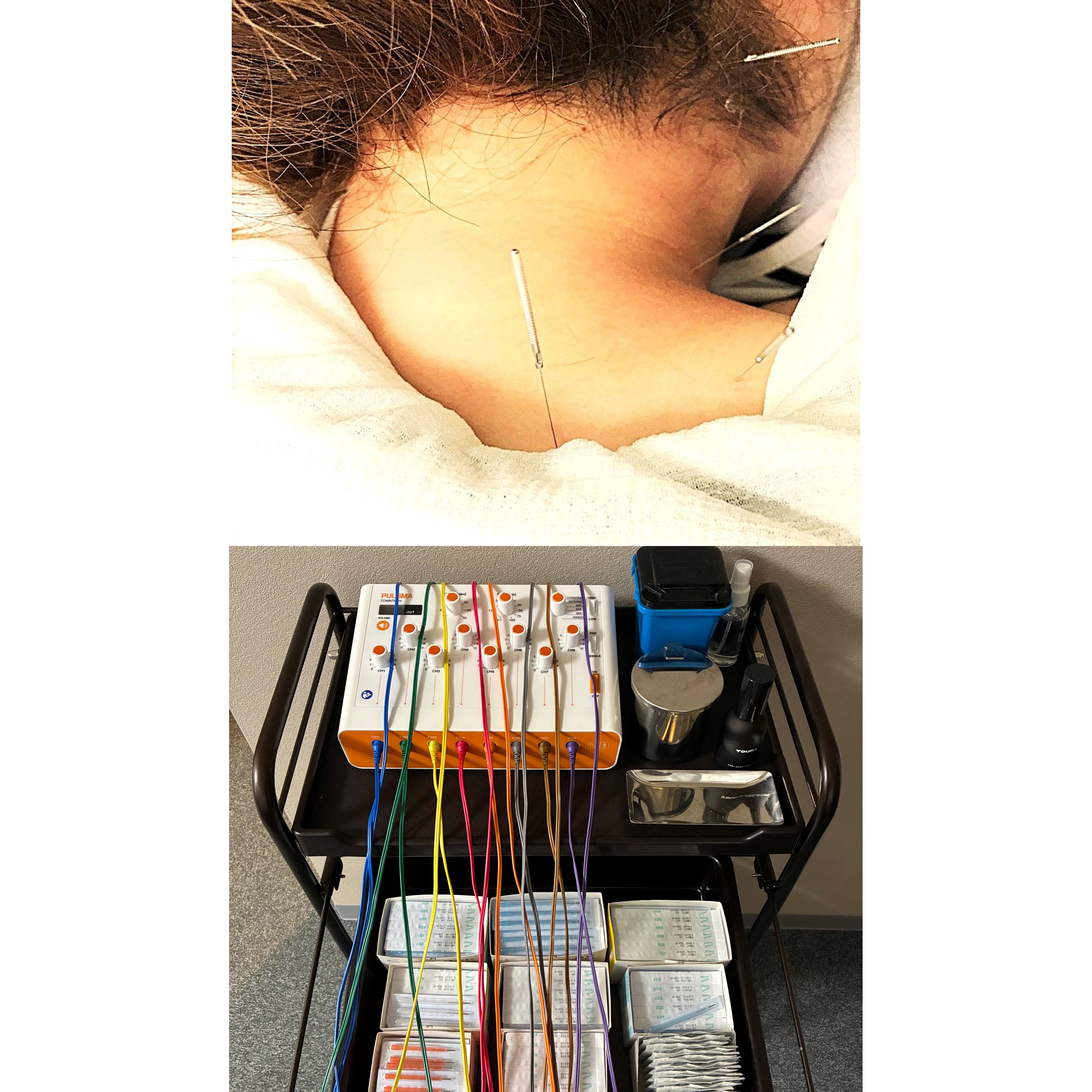 かみなかひかり鍼灸院接骨院 鍼灸治療ショートのメニュー画像