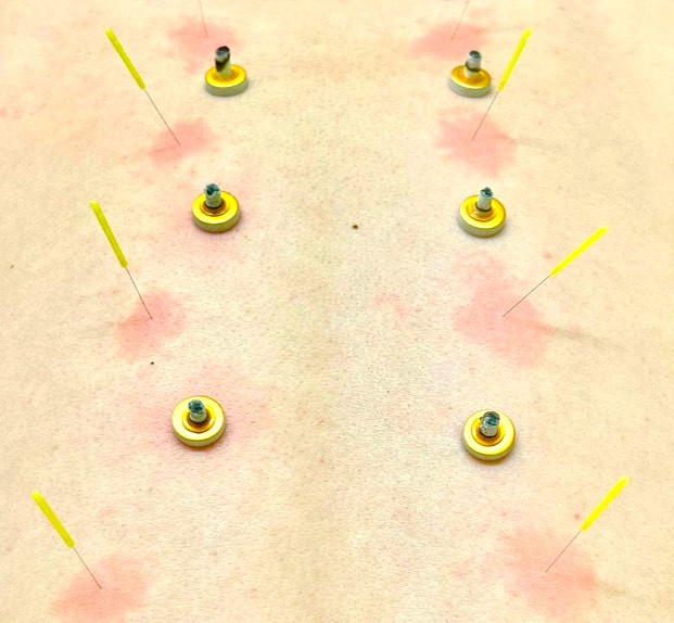 かみなかひかり鍼灸院接骨院 鍼灸治療ロングのメニュー画像