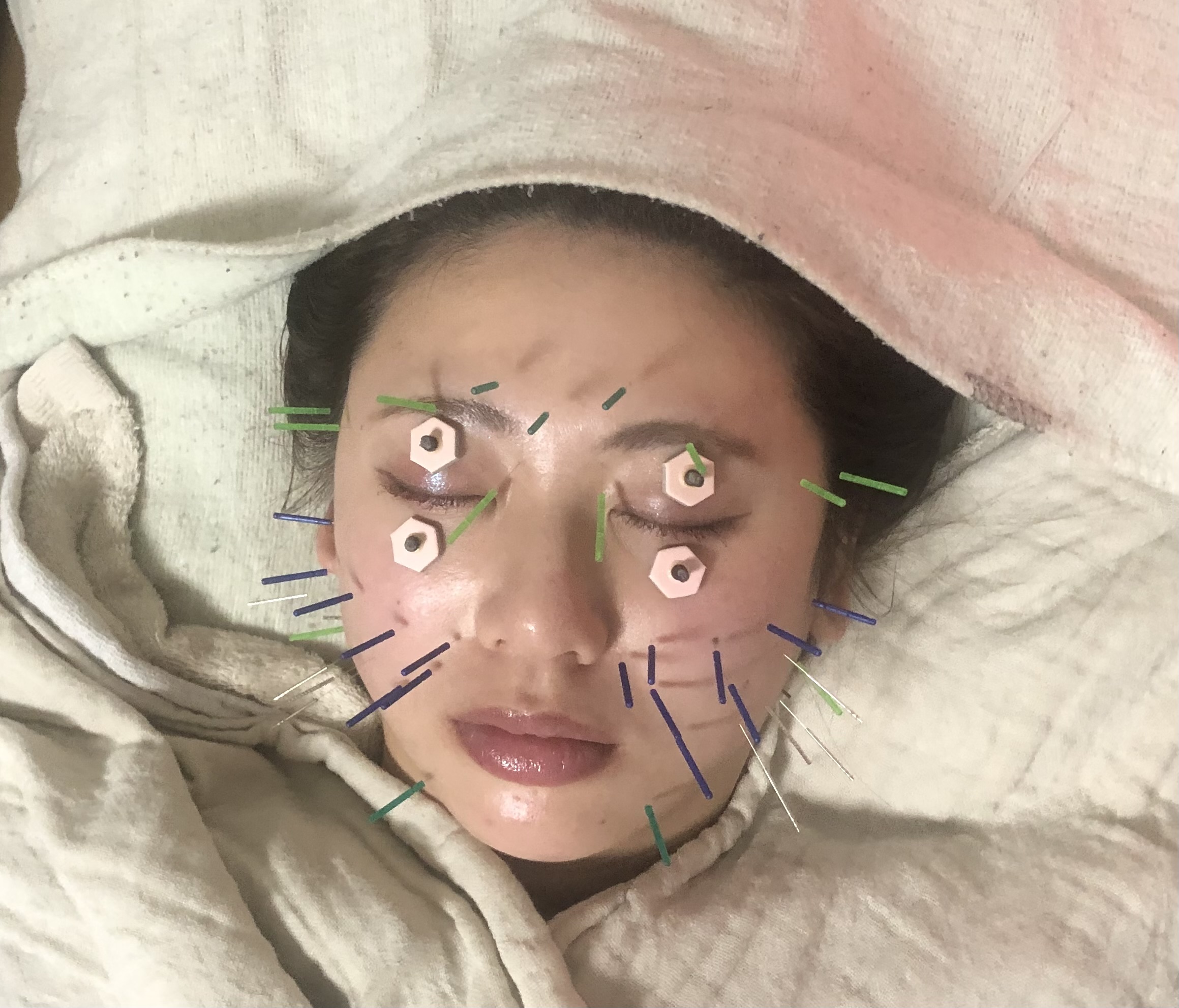 鍼灸マッサージインフィニティ 美容鍼灸　電気無し、妊娠中や電気刺激の苦手な方はこちらのメニュー画像