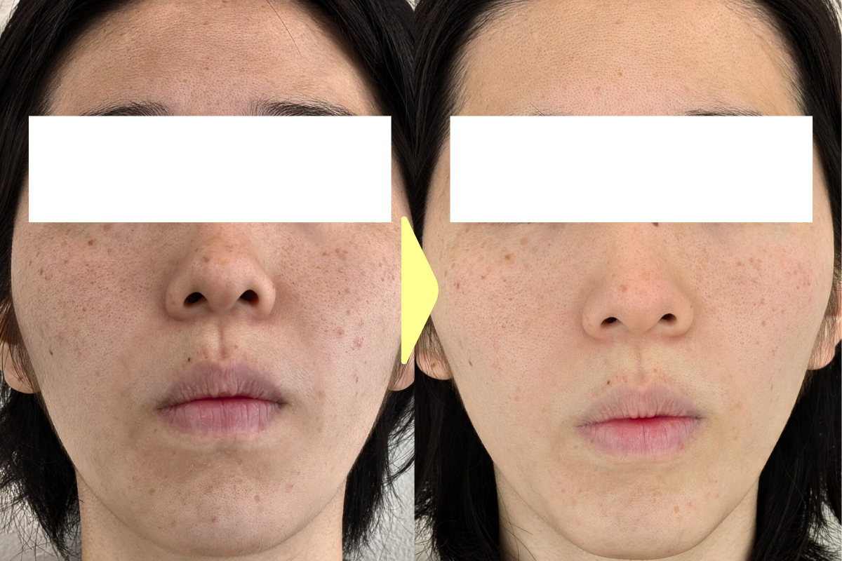 はりきゅうeFu -エフ- 【毎月1名様限定：12月残り1名、】✨️小ジワ・毛穴の悩みに好評✨️ヒト幹細胞美容鍼トライアルコースのメニュー画像