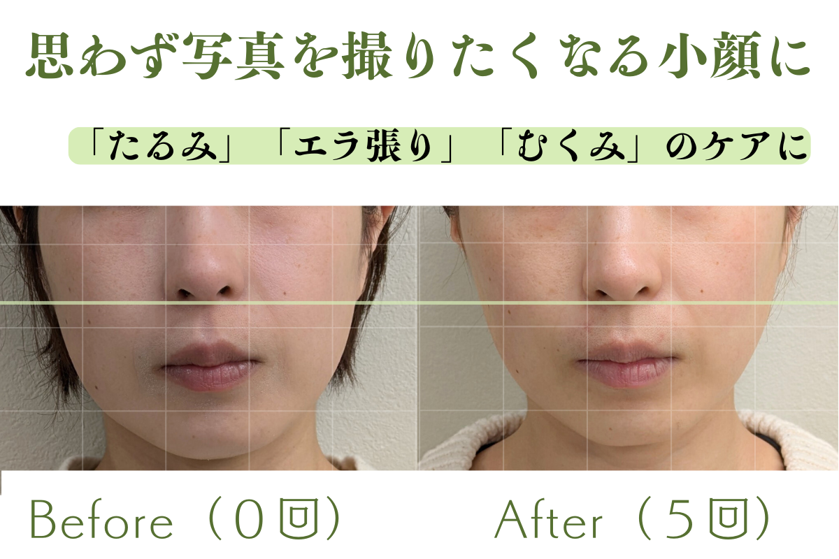 はりきゅうeFu -エフ- 【平日限定/毎月3名限定　残り：12月3名】『美容鍼』トライアルコース ☆オプションサービス/通常10,000円のメニュー画像