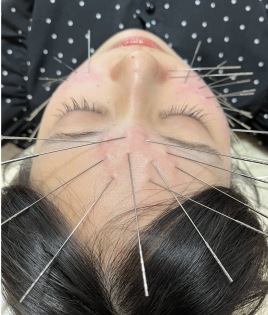 はり・きゅう「和と輪」　ルート治療専門院 👺整顔美容鍼【ルート治療】のメニュー画像