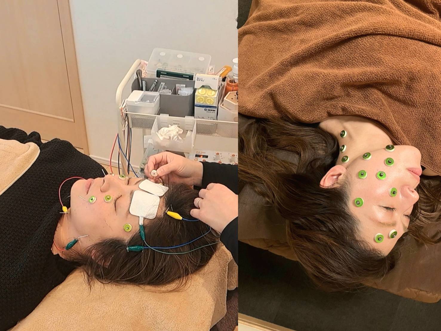 むすび治療院 【１２，1月限定　美容鍼灸ショートコース】のメニュー画像