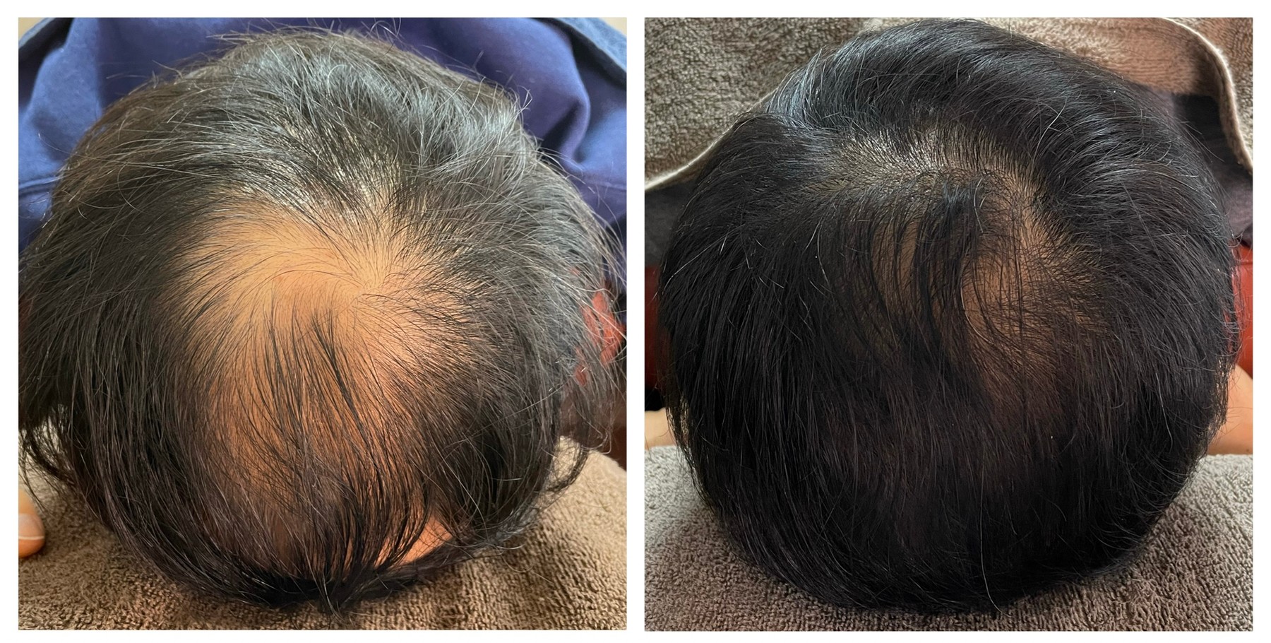 摂津本山駅前鍼灸整骨院 薄毛育毛改善鍼カウンセリング（初回体験）のメニュー画像