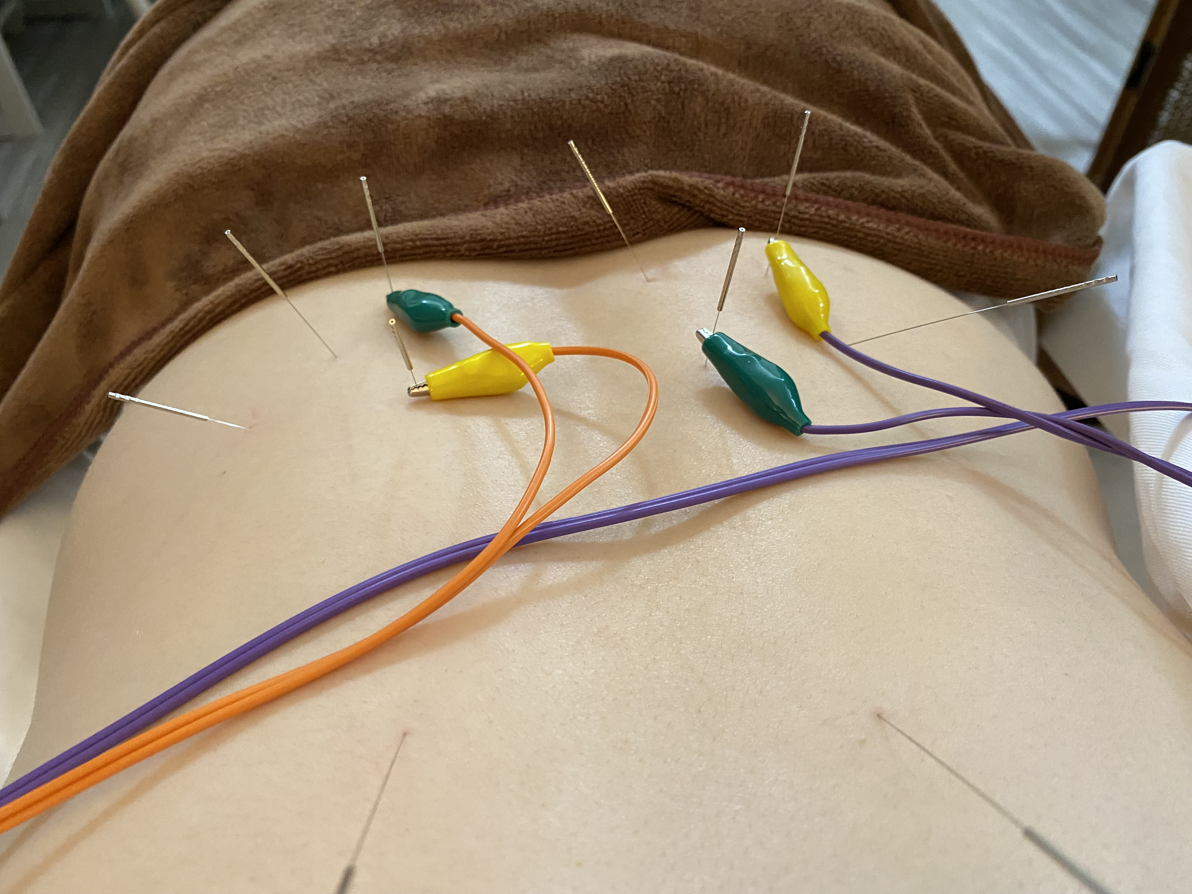 かめつ鍼灸院 肩こり、腰痛専門メニューのメニュー画像