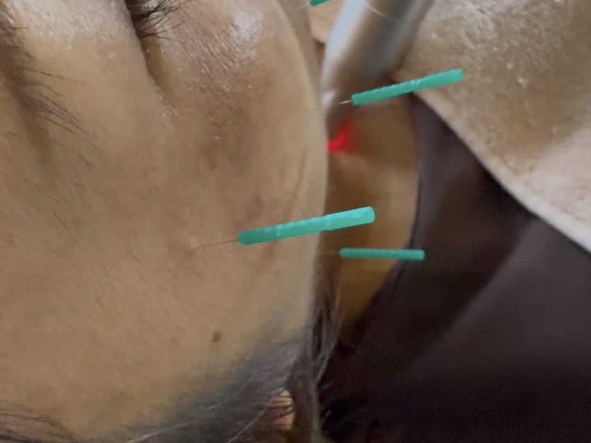 はりきゅう院さくら 初診の方はこちら/顔面神経麻痺のメニュー画像