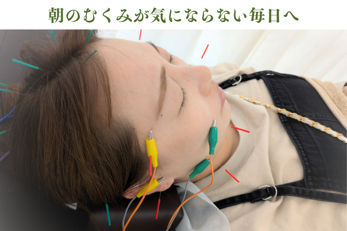 はりきゅうeFu -エフ- 【2回目以降】リフトアップ美容鍼のメニュー画像