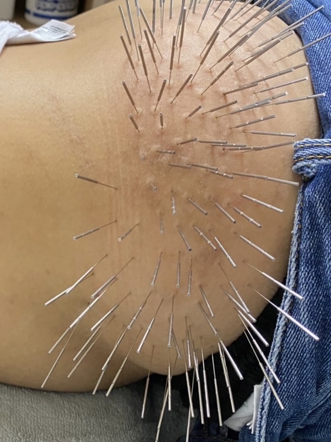 ルート治療専門　ながえ鍼灸院 ルート治療３０分☆急性的な症状、ギックリ腰、寝違い、捻挫でお困りの方☆のメニュー画像