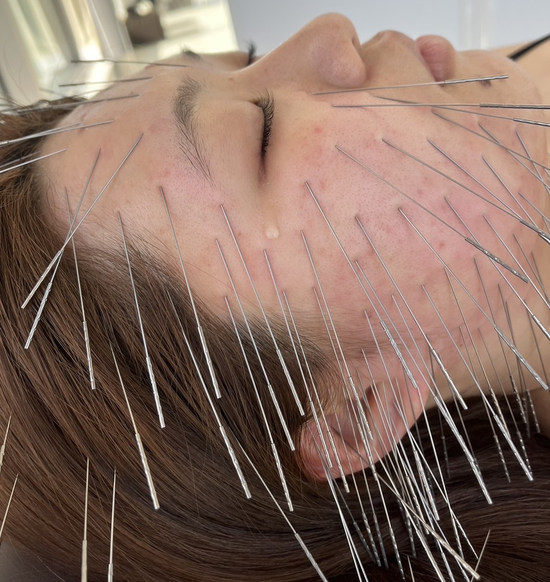 鍼秋田別院〜ルート治療専門院〜 鬼美容鍼集中コース【即帰宅される方限定！】のメニュー画像