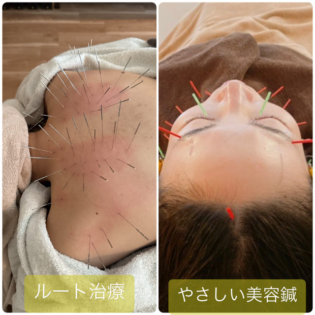 美容鍼灸サロン マックスビューティー ルートアライメント鍼のメニュー画像