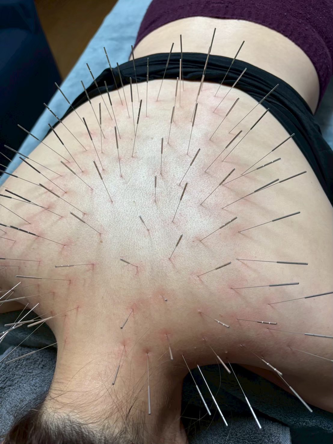 鍼打人　Aomori    ルート治療 ルート鍼30分のメニュー画像