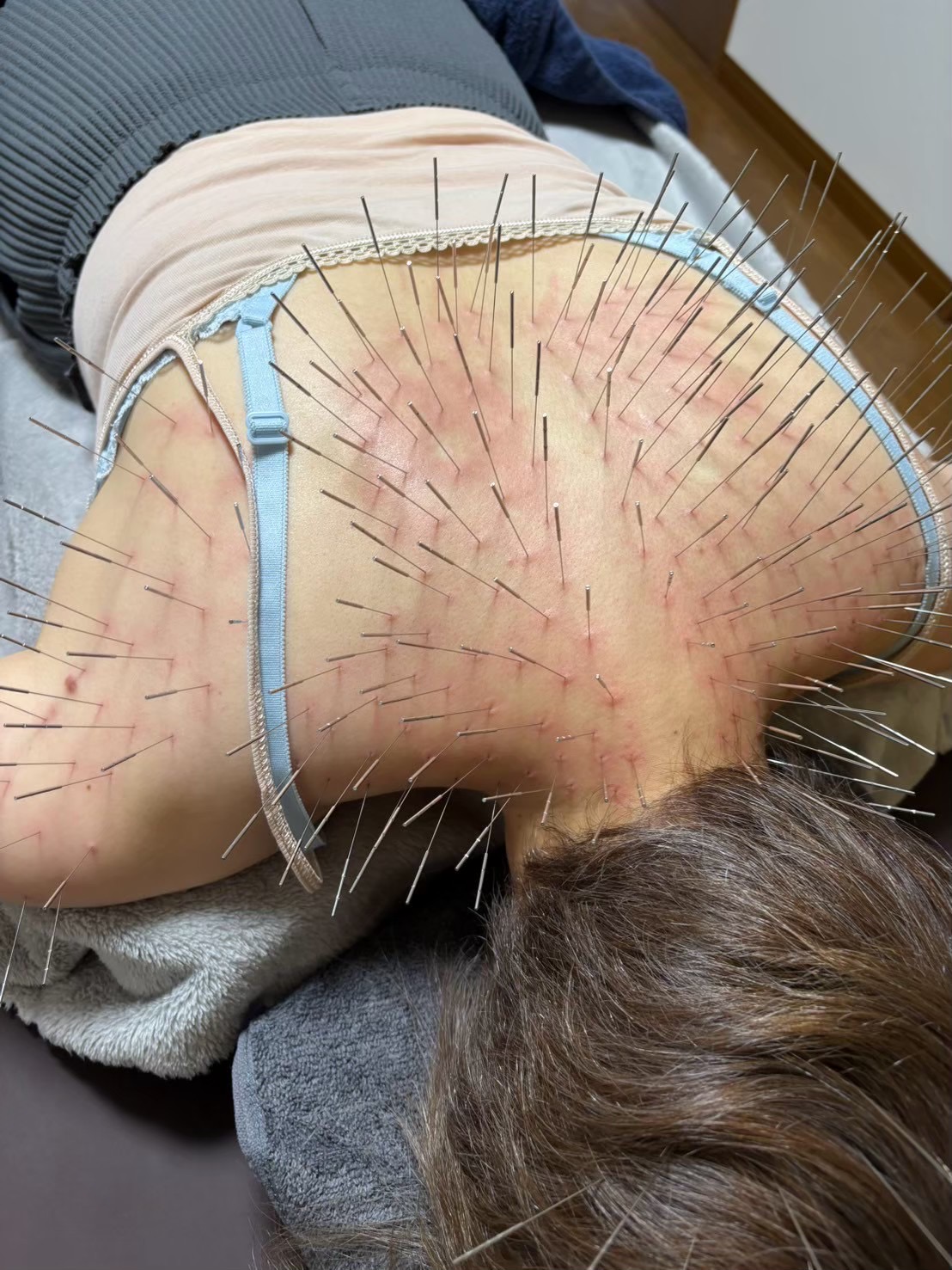 鍼打人　Aomori    ルート治療 ルート鍼90分のメニュー画像