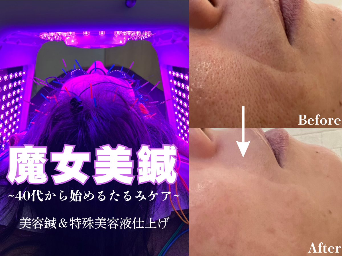 HARIS美容鍼灸整体院 40代からの魔女美鍼　たるみ・しわ・毛穴ケア　19800円→9800円	のメニュー画像