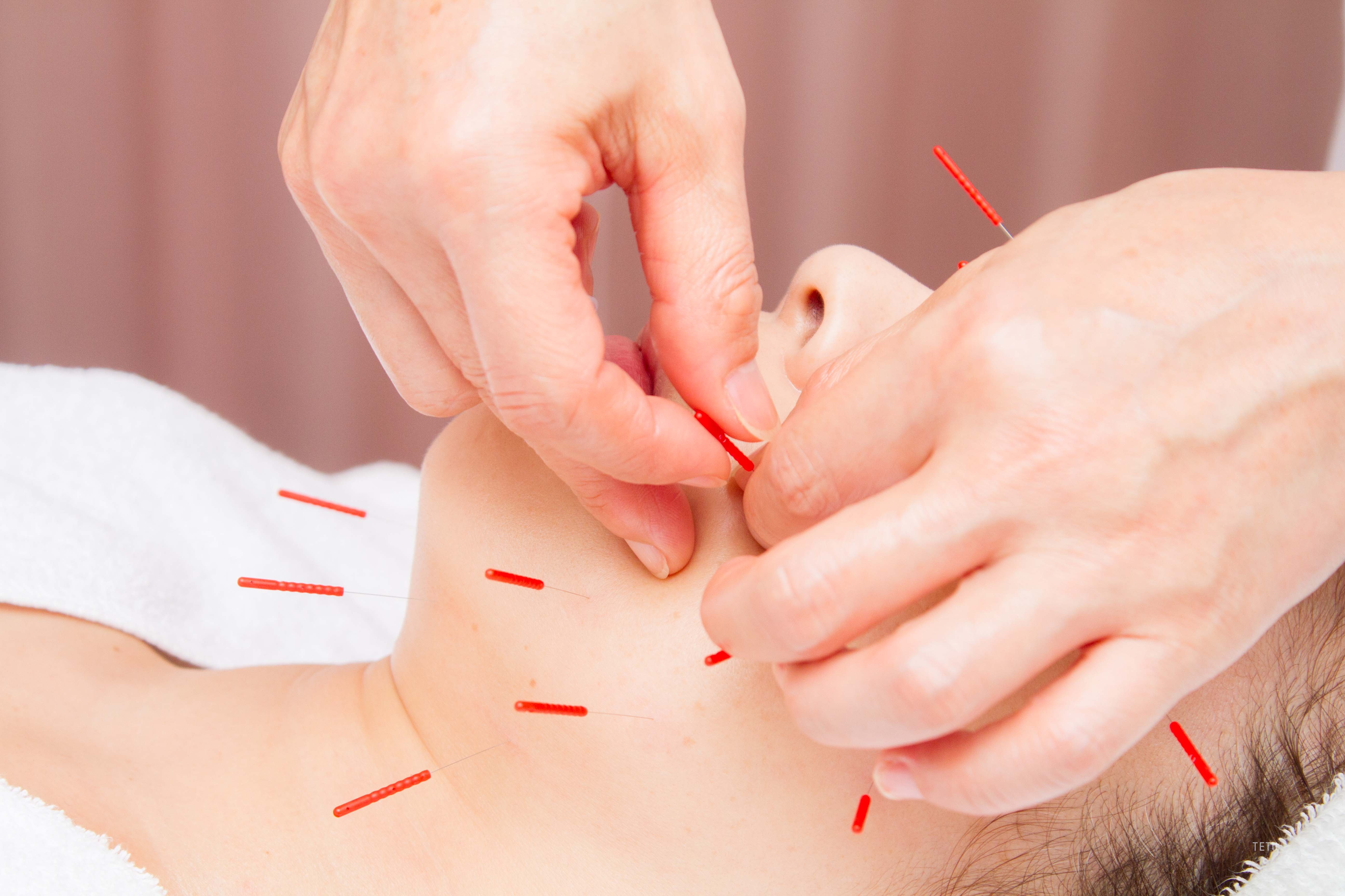 プライベート鍼灸院　SHINーRYU 美容鍼のメニュー画像