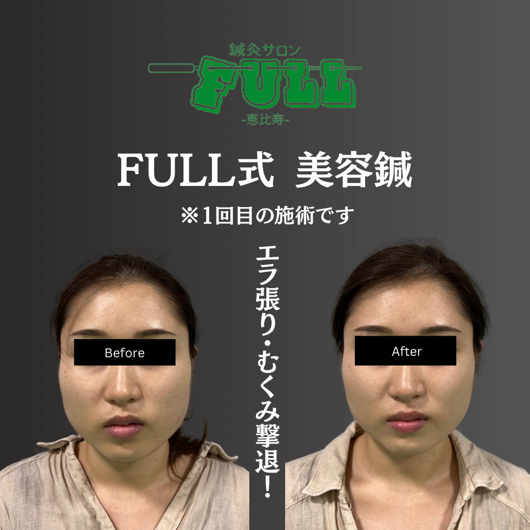 鍼灸サロンFULL恵比寿 【小顔も身体も整えたい方におすすめ】美容鍼✖︎姿勢改善コースのメニュー画像