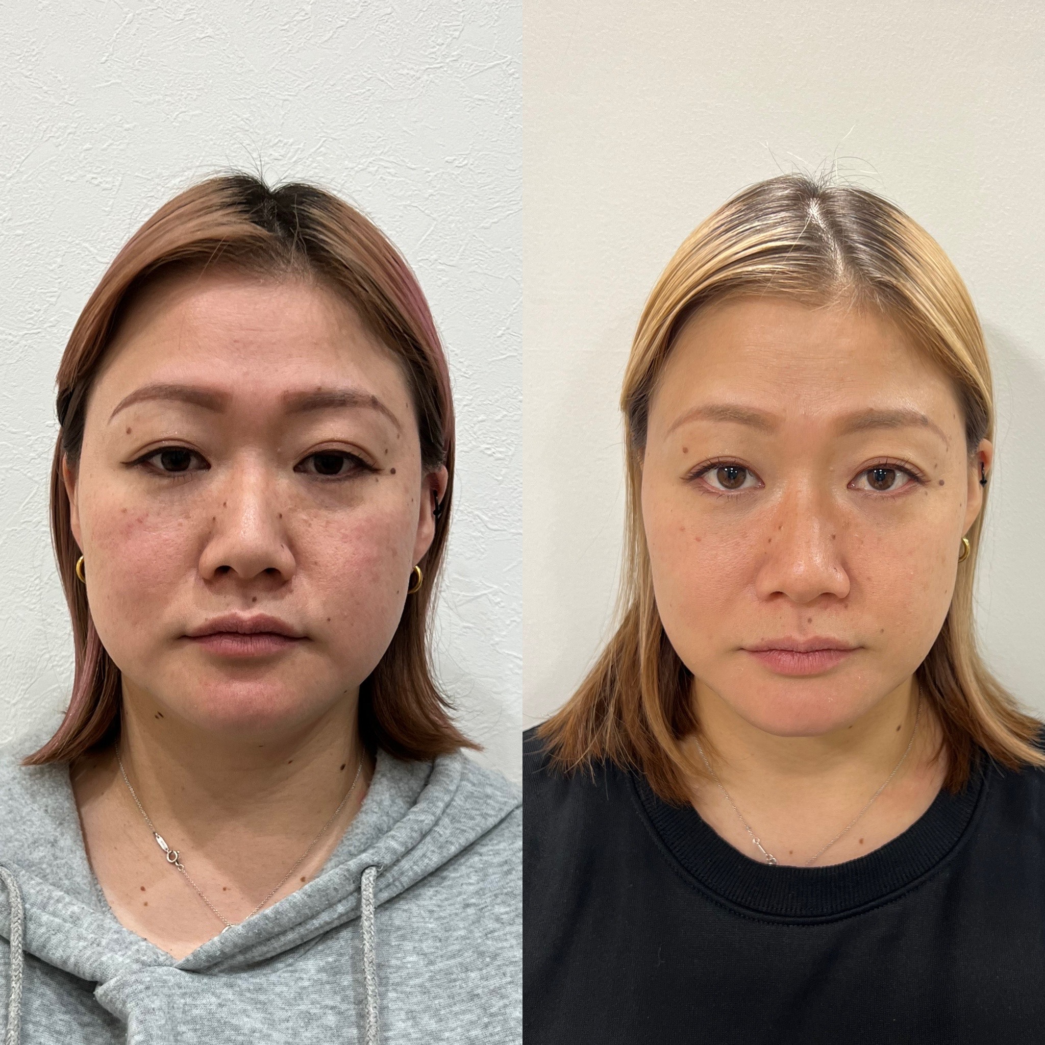 たいよう鍼灸院（八日市/薄毛鍼/美容鍼/特化型鍼灸整骨院） 鬼美容鍼ショートのメニュー画像