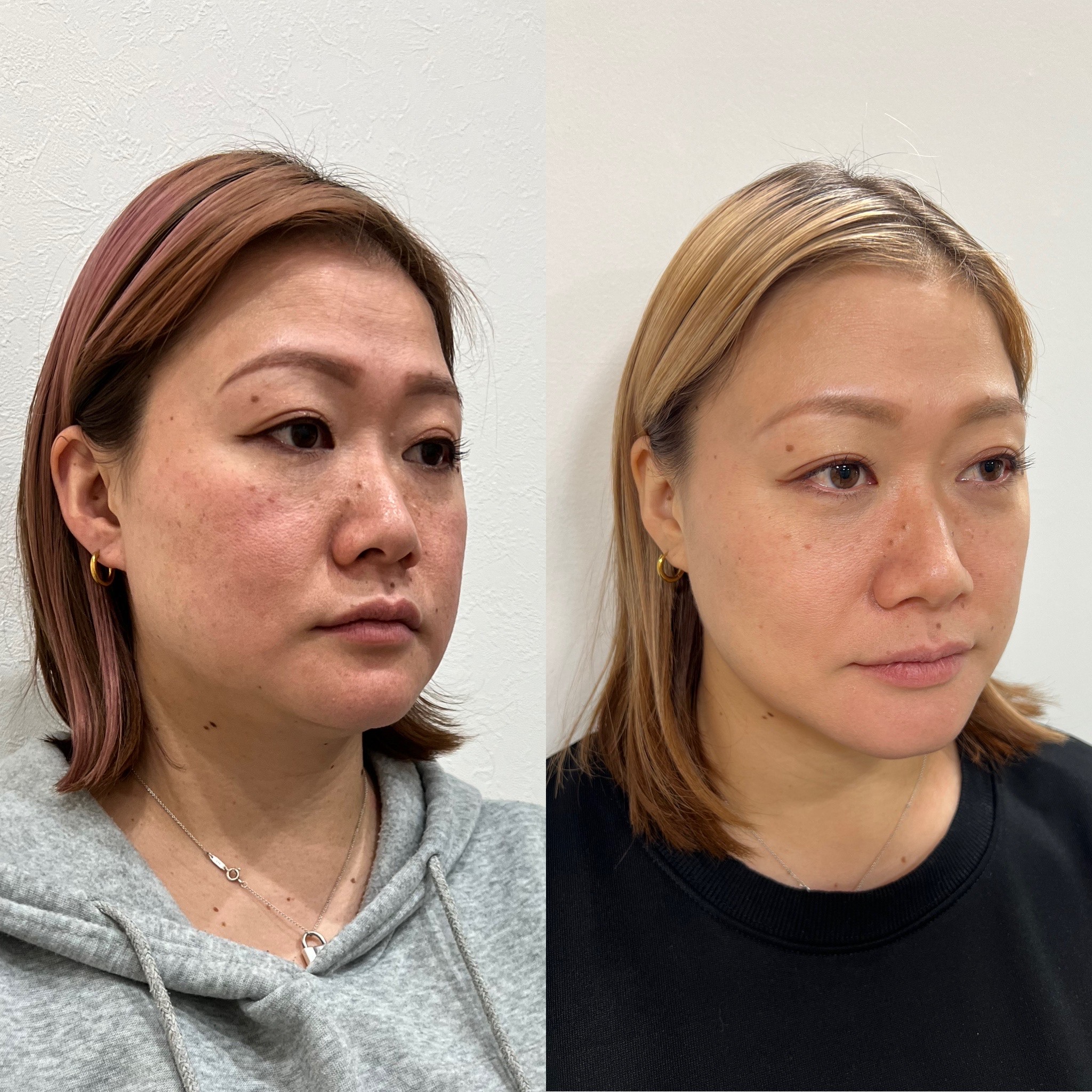 たいよう鍼灸院（八日市/薄毛鍼/美容鍼/特化型鍼灸整骨院） 鬼美容鍼ショートのメニュー画像