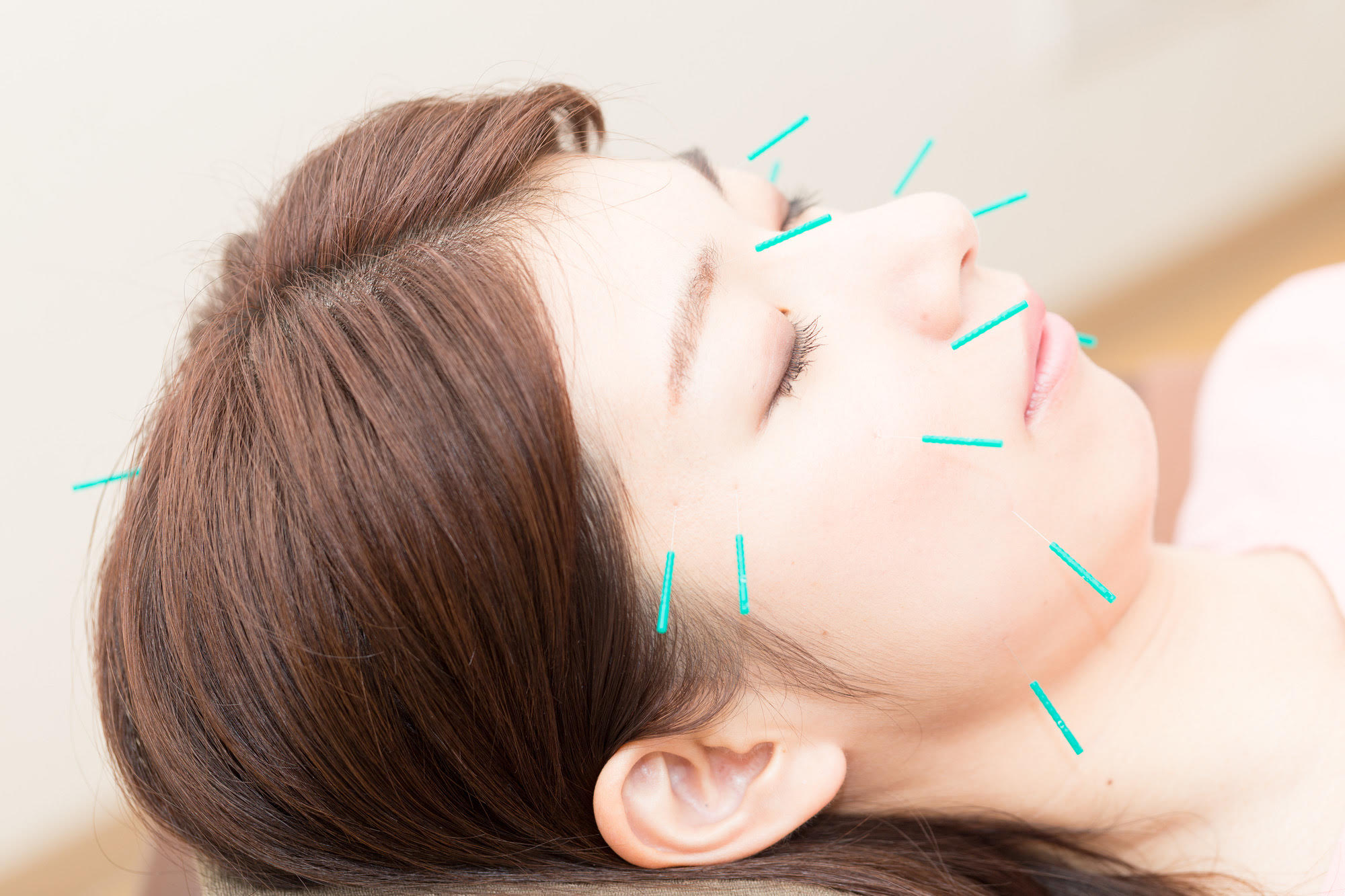 からだバランス鍼灸整体院難波駅前店 【お試し】8000→63％引き2980円　小町美顔鍼＋トルクリリース肩こり予防のメニュー画像