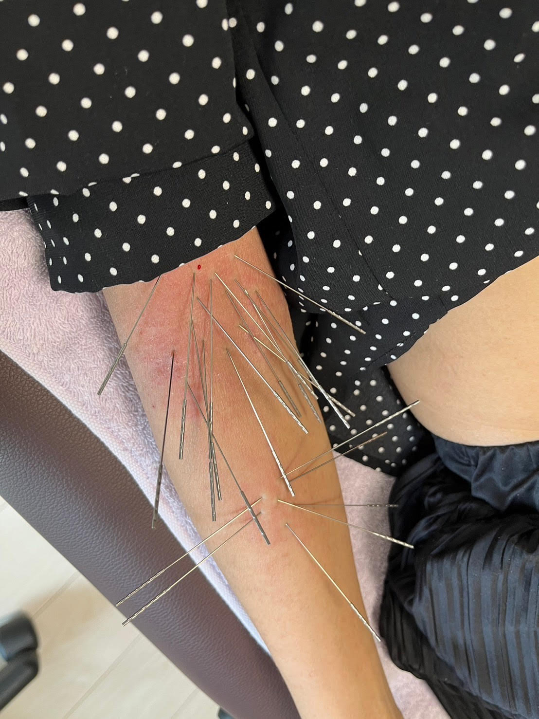 からだバランス鍼灸整体院難波駅前店 【お試し】小町ルート鍼お試し30分6000円　アトピー施術のメニュー画像