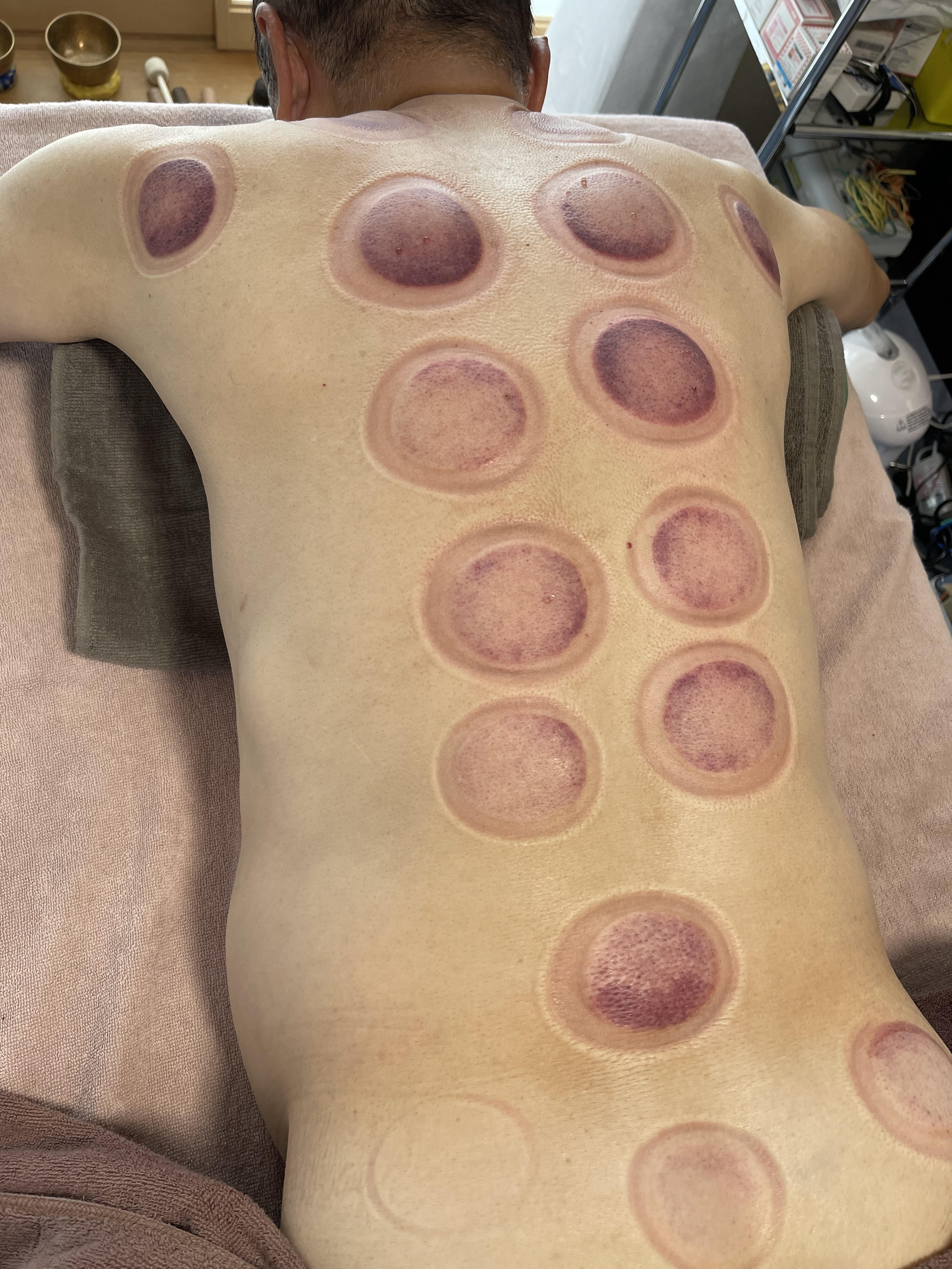 からだバランス鍼灸整体院難波駅前店 「お試し5980円」8800円→5980円　小町鍼灸×吸い玉のメニュー画像