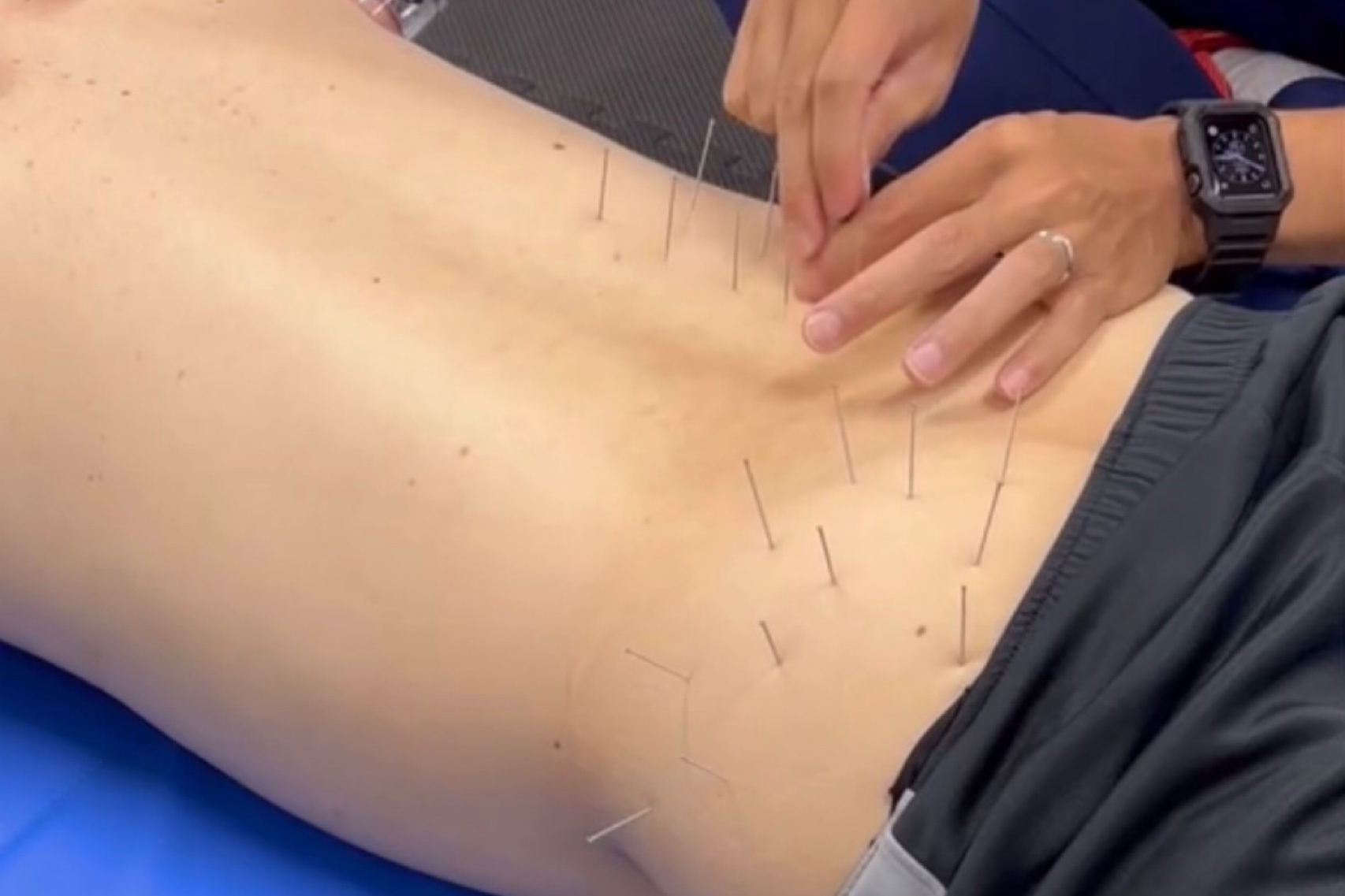 浦添てるてる鍼灸整骨院×teru.fit 90分鍼灸整体治療〈初診の方もおすすめ〉のメニュー画像