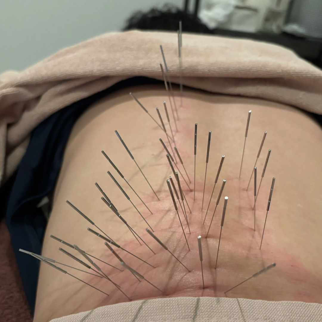 ルート治療HARIーUP ルート治療ライト（部分コース）のメニュー画像