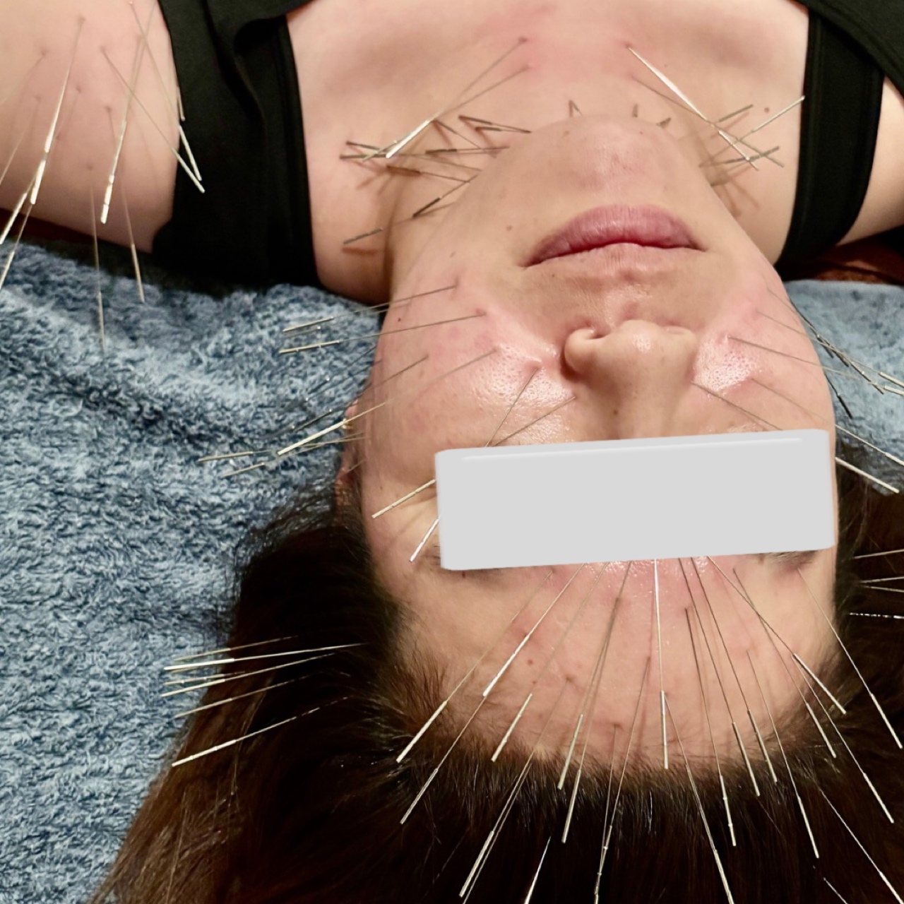 ルート治療HARIーUP ルート治療プレミアム（1.5倍コース）のメニュー画像