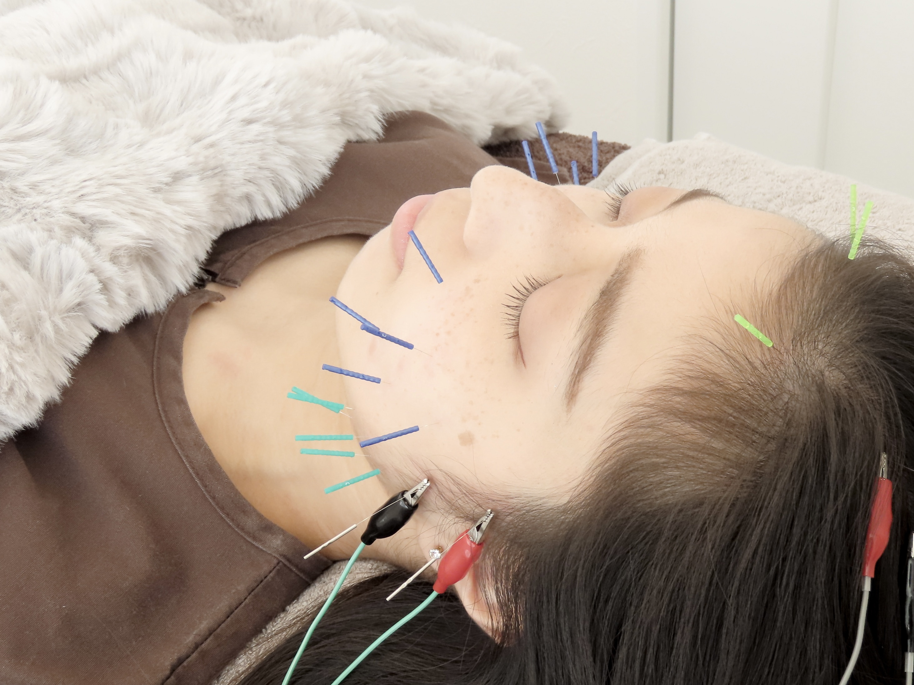 Ruria鍼灸サロン 人気No.1【くいしばり美容鍼×首肩こり】60分12,800円→(初回)7,700円のメニュー画像