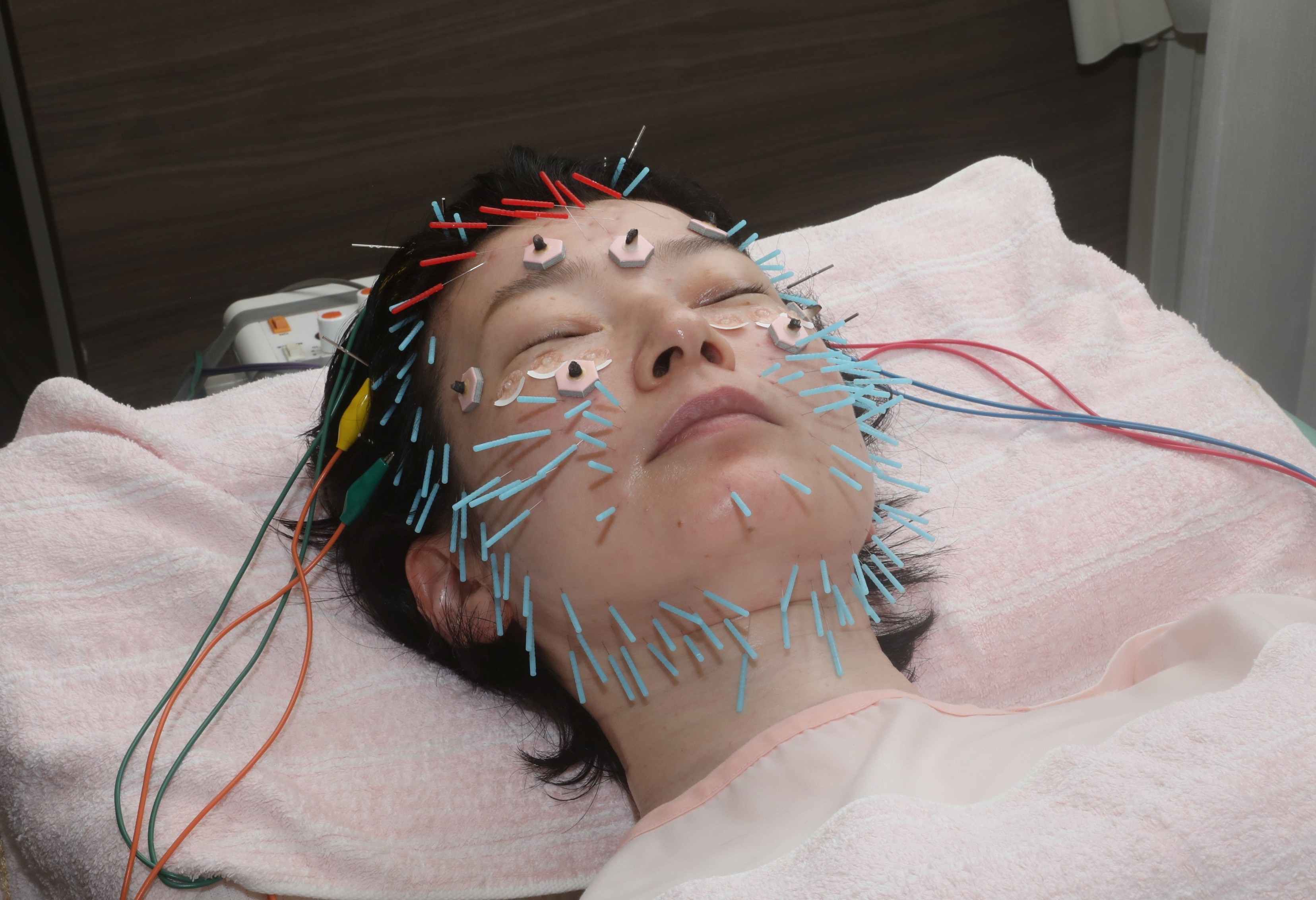 おべ鍼灸院 美容鍼　２回回数券のメニュー画像