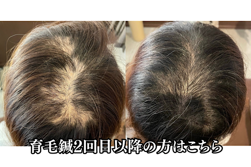 【美容鍼・育毛鍼】きよもと鍼灸院 【育毛鍼2回目以降の方はこちら】のメニュー画像