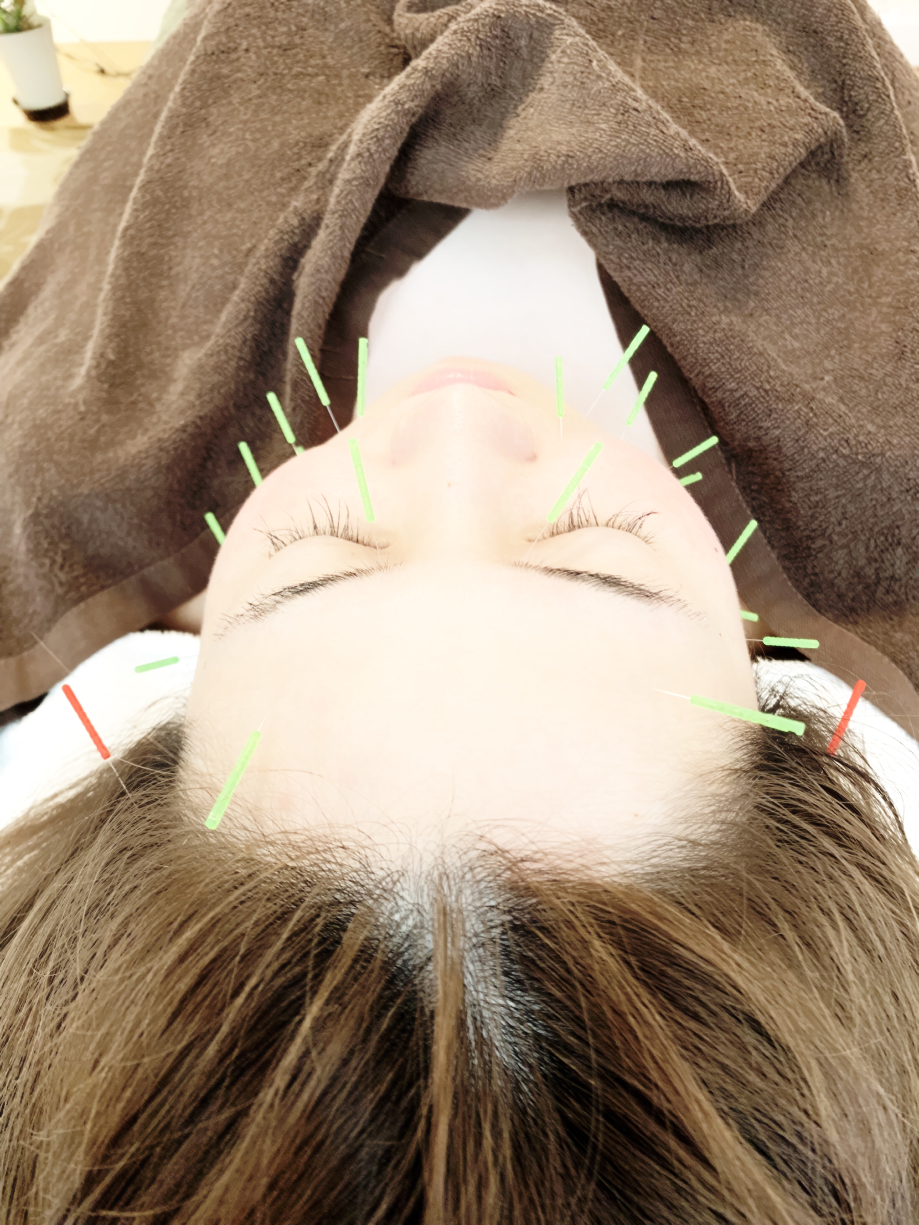 古民家Kanaloa 美容鍼★小顔かっさフェイシャル(ヘッド＆美肌パック付) のメニュー画像