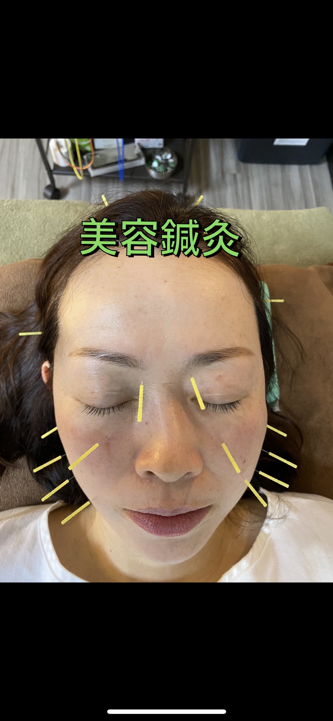 かめつ鍼灸院 【限定】美容鍼 小顔＋リフトアップのメニュー画像