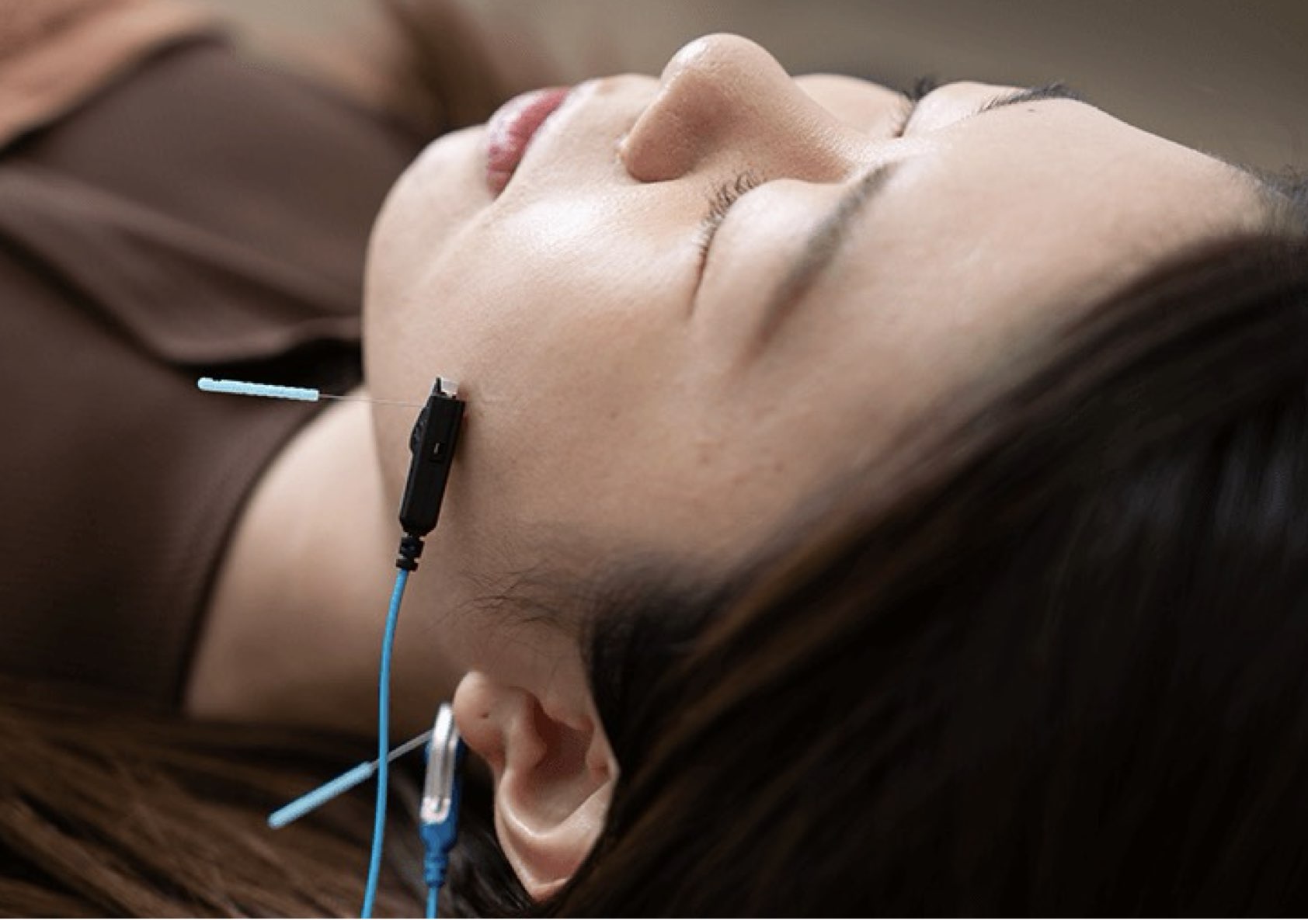 はりと灸　晴る 初回限定価格！ベースアップ美容鍼　お肌を基礎から改善！のメニュー画像