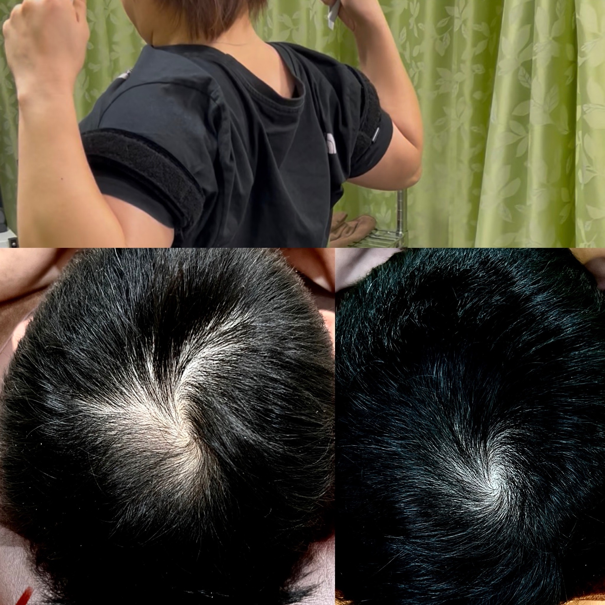 たいよう鍼灸院（八日市/薄毛鍼/美容鍼/特化型鍼灸整骨院） 育毛促進鍼 × 血流改善のメニュー画像