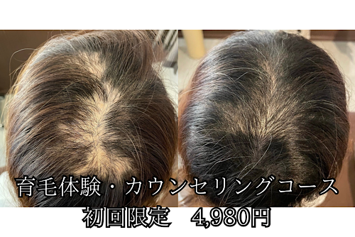 【美容鍼・育毛鍼】きよもと鍼灸院 【薄毛・抜け毛】育毛体験・カウンセリングコースのメニュー画像