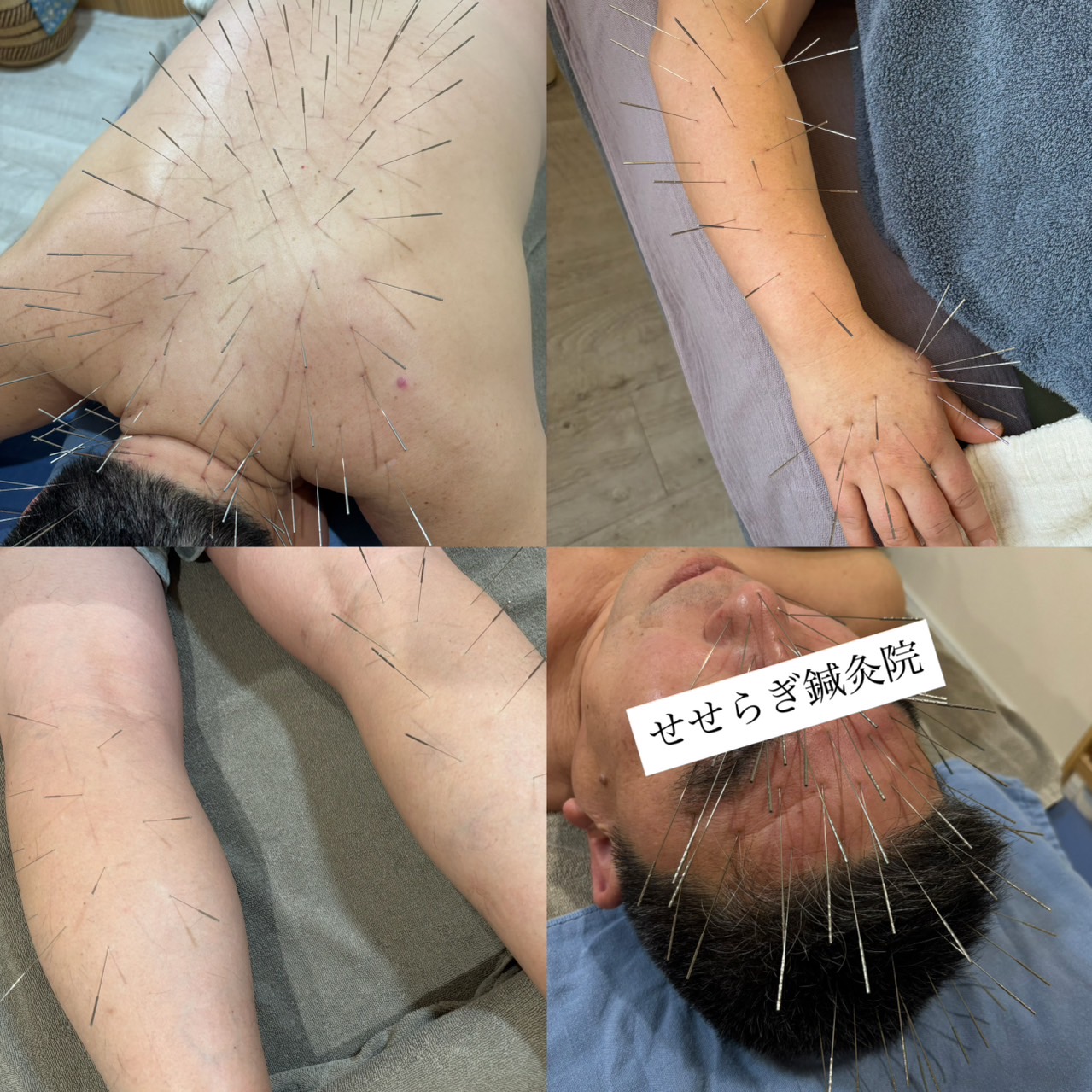 せせらぎ鍼灸院　ルート治療 ルート治療90分のメニュー画像