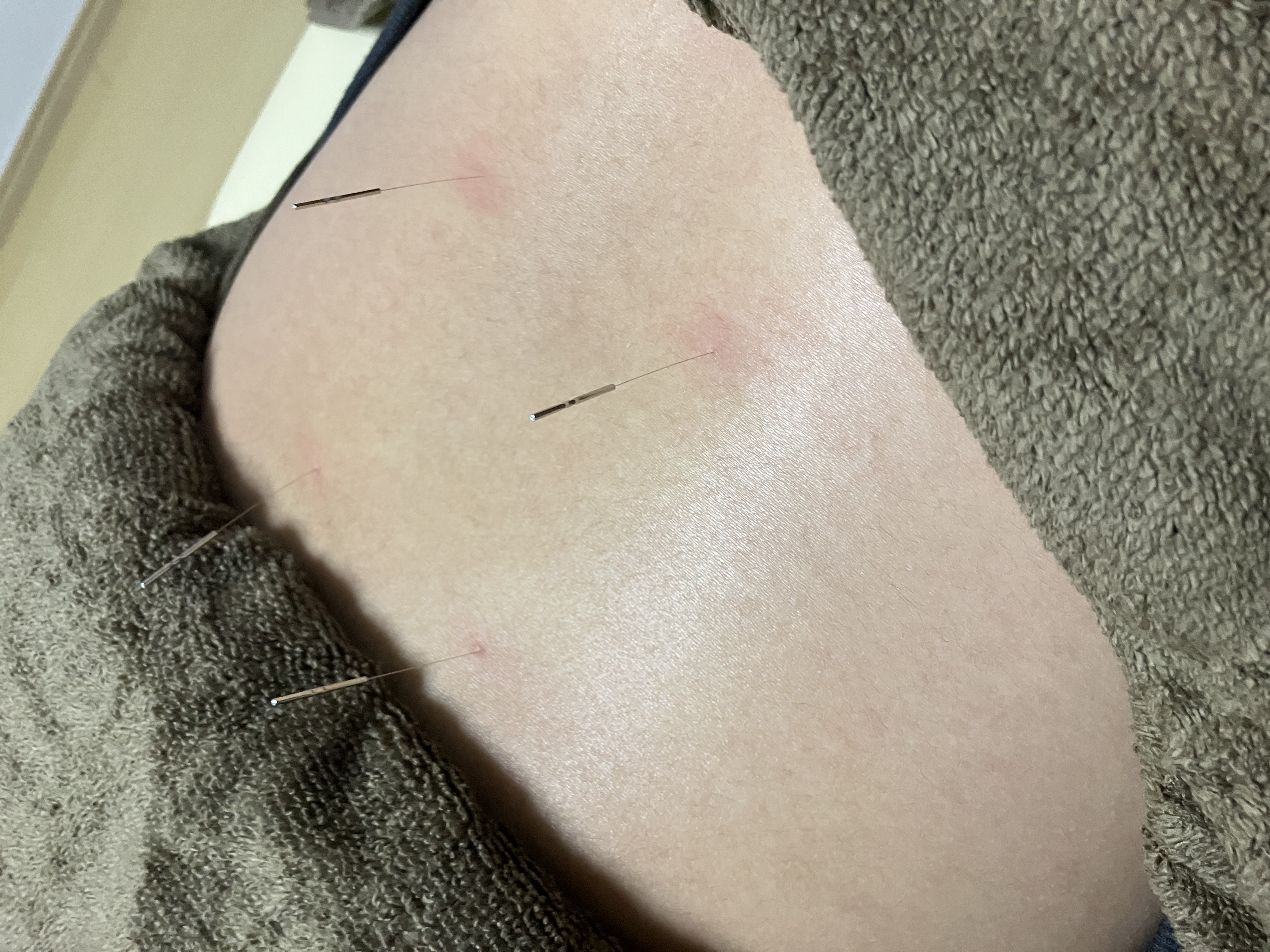 湯結鍼灸院 自律神経調整鍼のメニュー画像