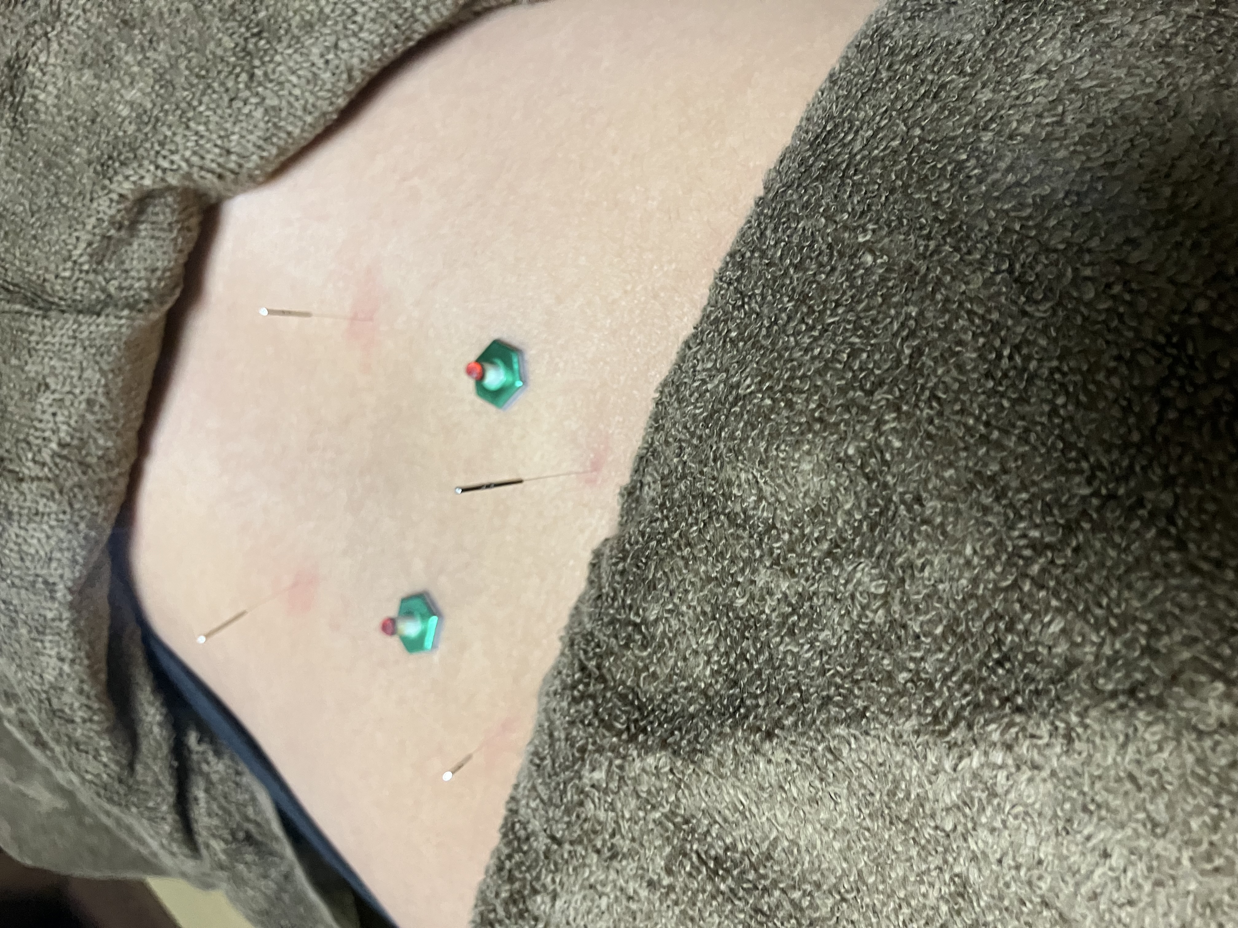 湯結鍼灸院 鍼灸一部位追加のメニュー画像