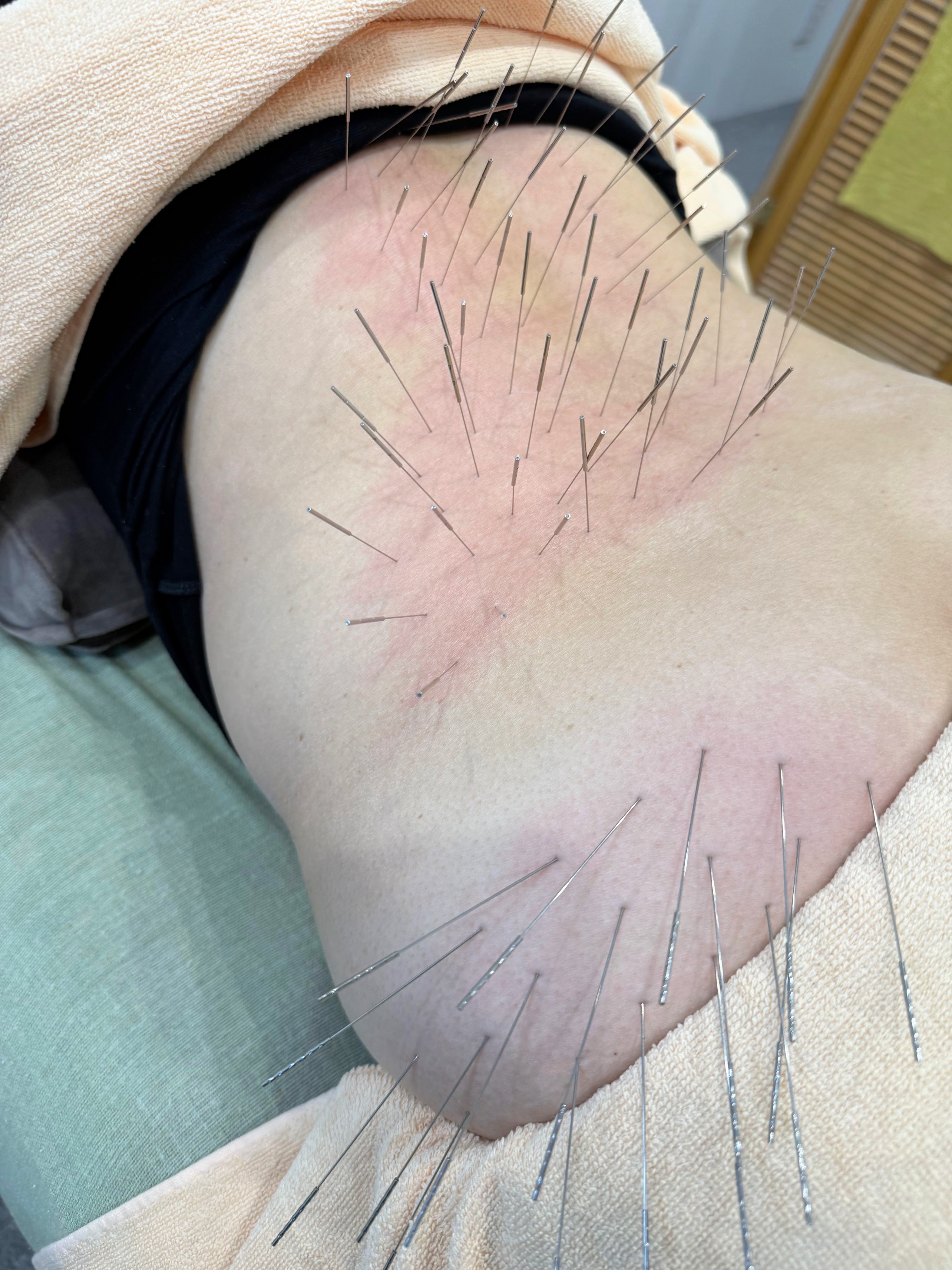 寿貴鍼灸院【ルート治療専門院】 40分コースのメニュー画像