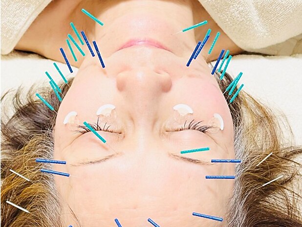 小顔美容鍼・鍼灸院 UTUKUSHI 【人気No.1】《1度で効果実感》美容鍼＋100％生ヒト幹細胞液導入＋毛穴洗浄のメニュー画像