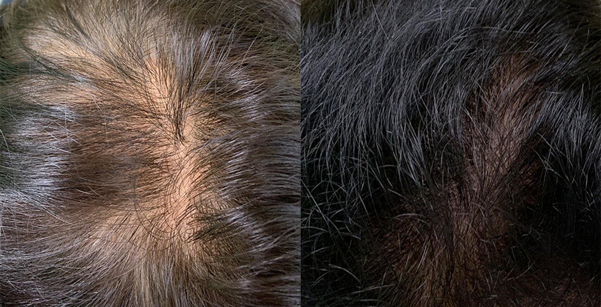 なばな鍼灸院（剛鍼灸院グループ） 薄毛鍼灸治療　初診のメニュー画像