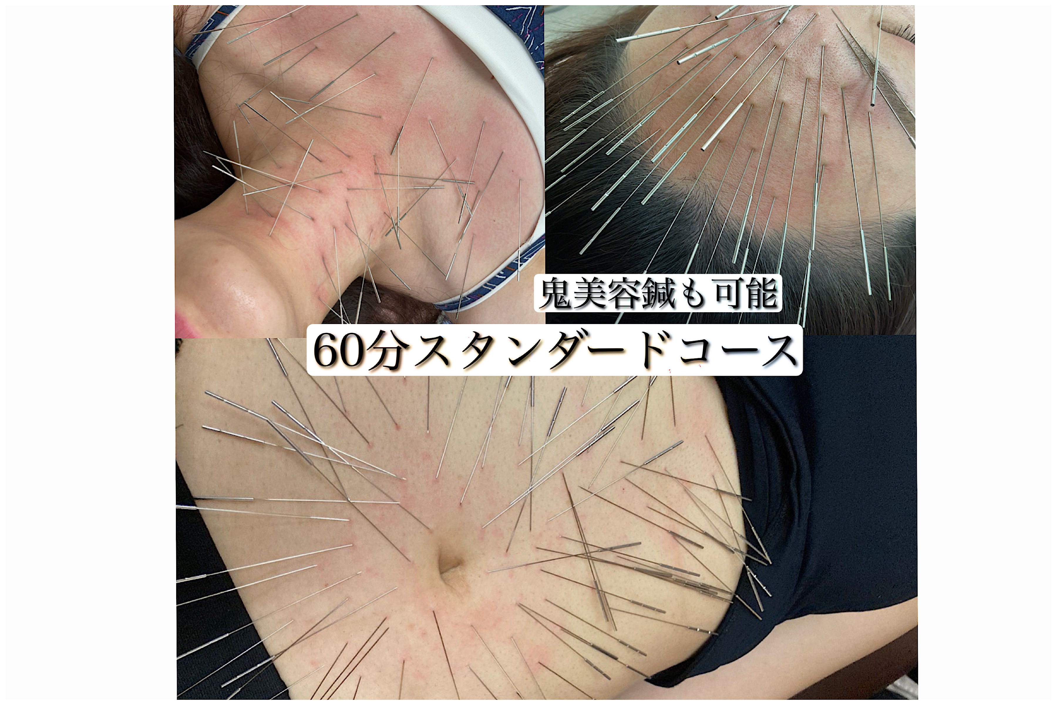 みやけ鍼灸院（ルート治療） ルート治療60分　スタンダードのメニュー画像