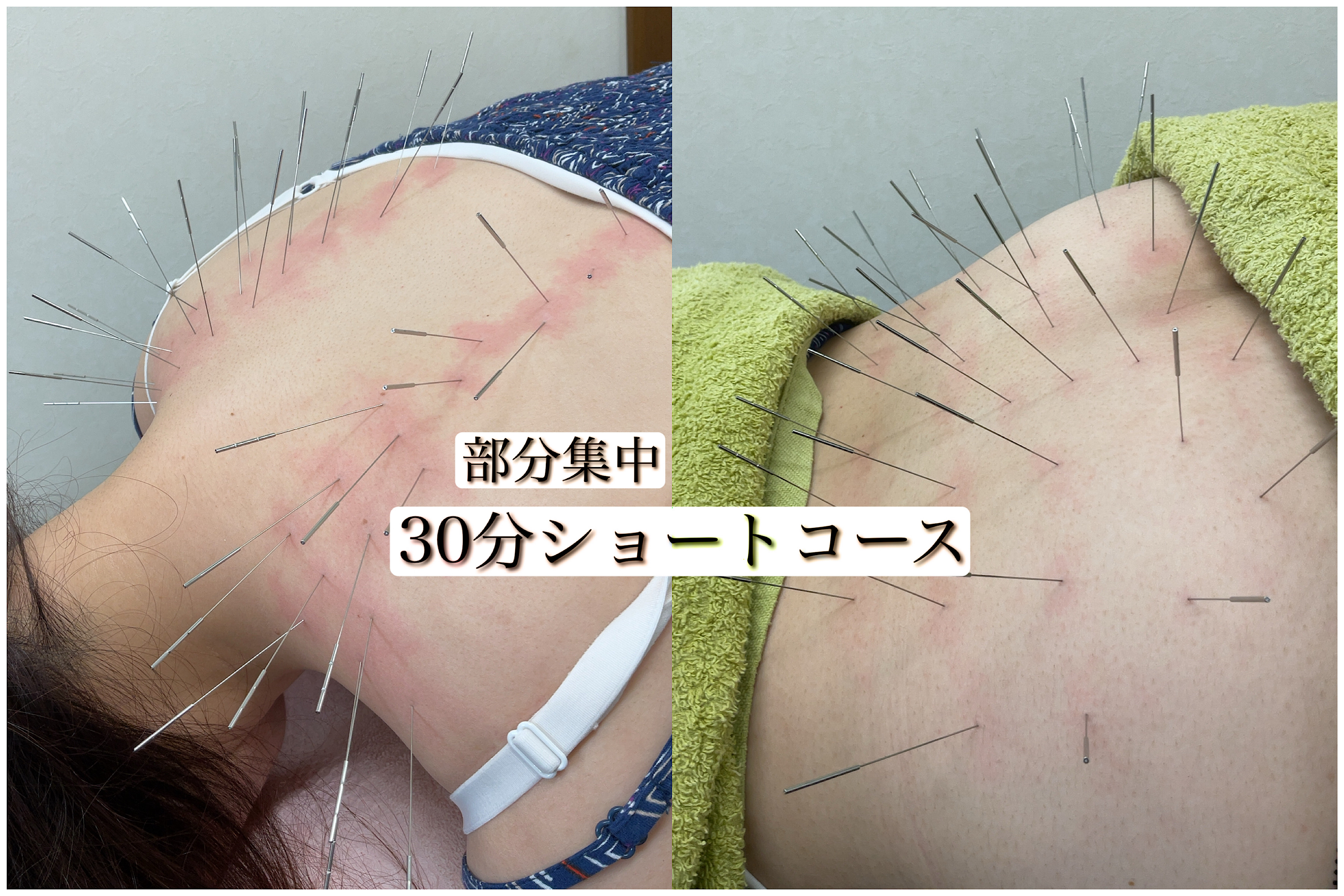 みやけ鍼灸院（ルート治療） ルート治療30分　ショートのメニュー画像