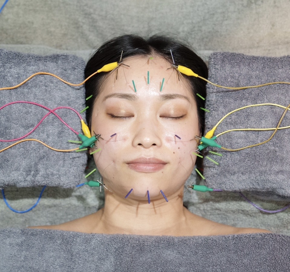  鍼灸まほろば KAGARI-Bi −Beauty & Body Care− お顔のみの美容鍼 9,500〜10,500円のメニュー画像