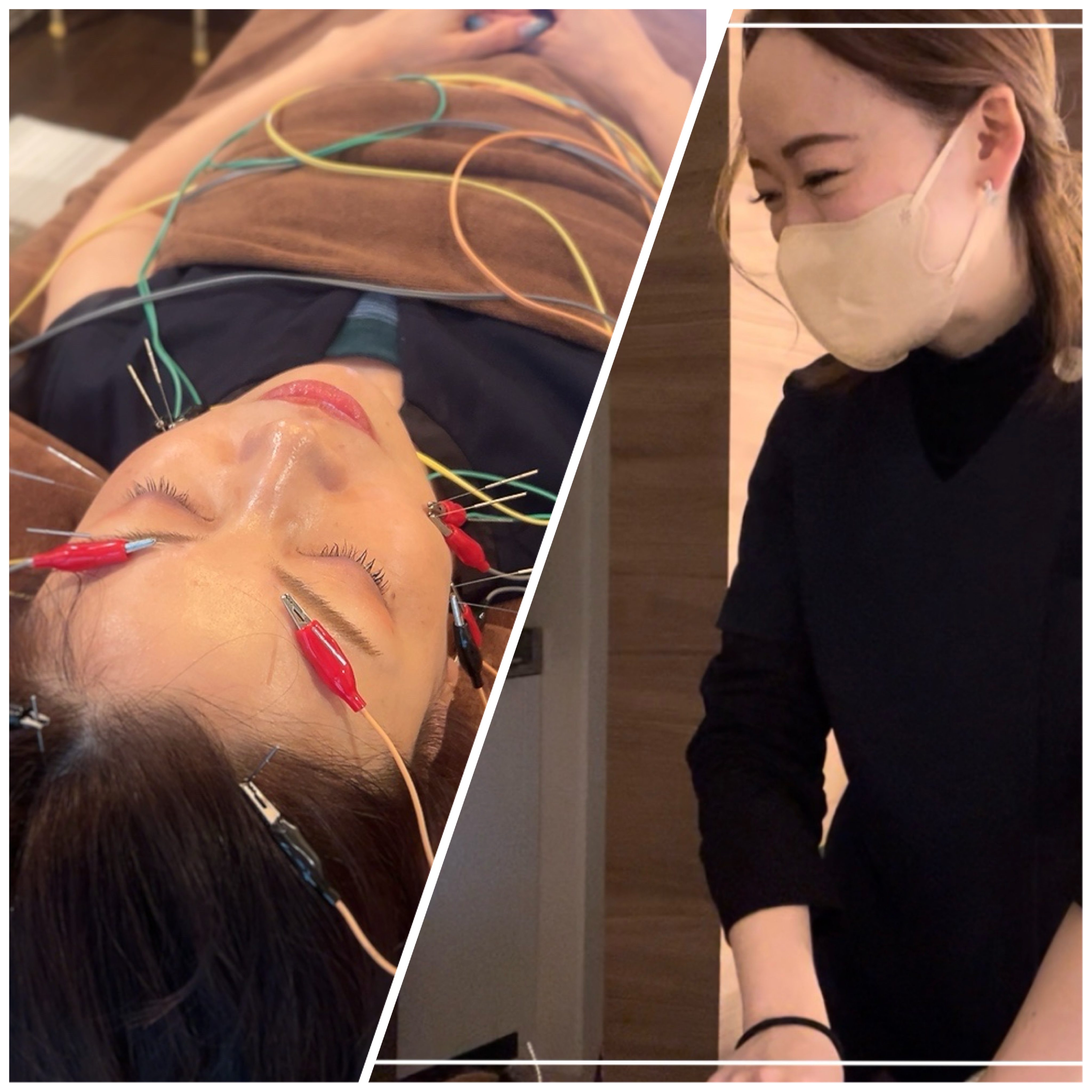 コトハリ 【新規✨】電気を流す美容鍼+体の鍼 90分のメニュー画像