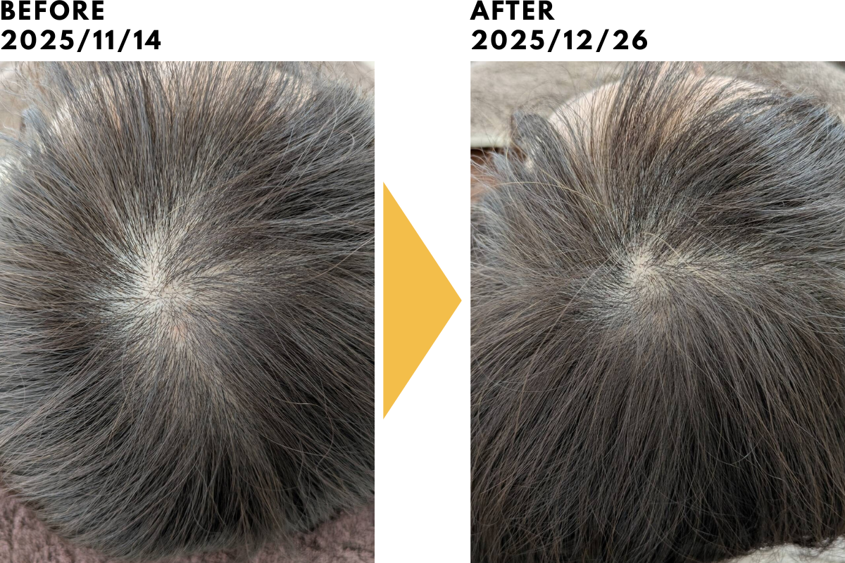 はりきゅうeFu -エフ- 【毎月3名限定：2月残り1名、3月3名】育毛鍼トライアルコースのメニュー画像