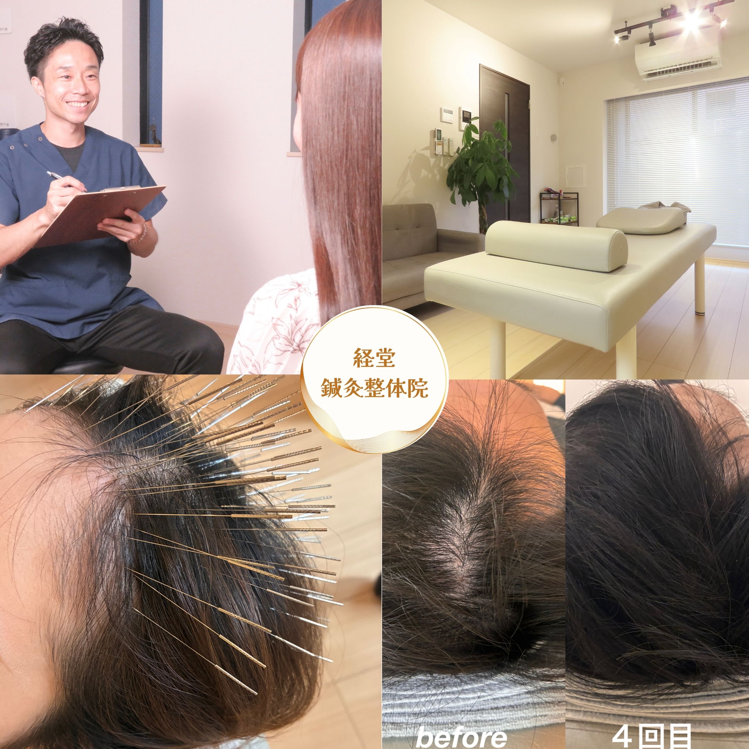 経堂鍼灸整体院 【育毛鍼】鍼×ヒト幹細胞培養液｜カウンセリング＋施術体験のメニュー画像