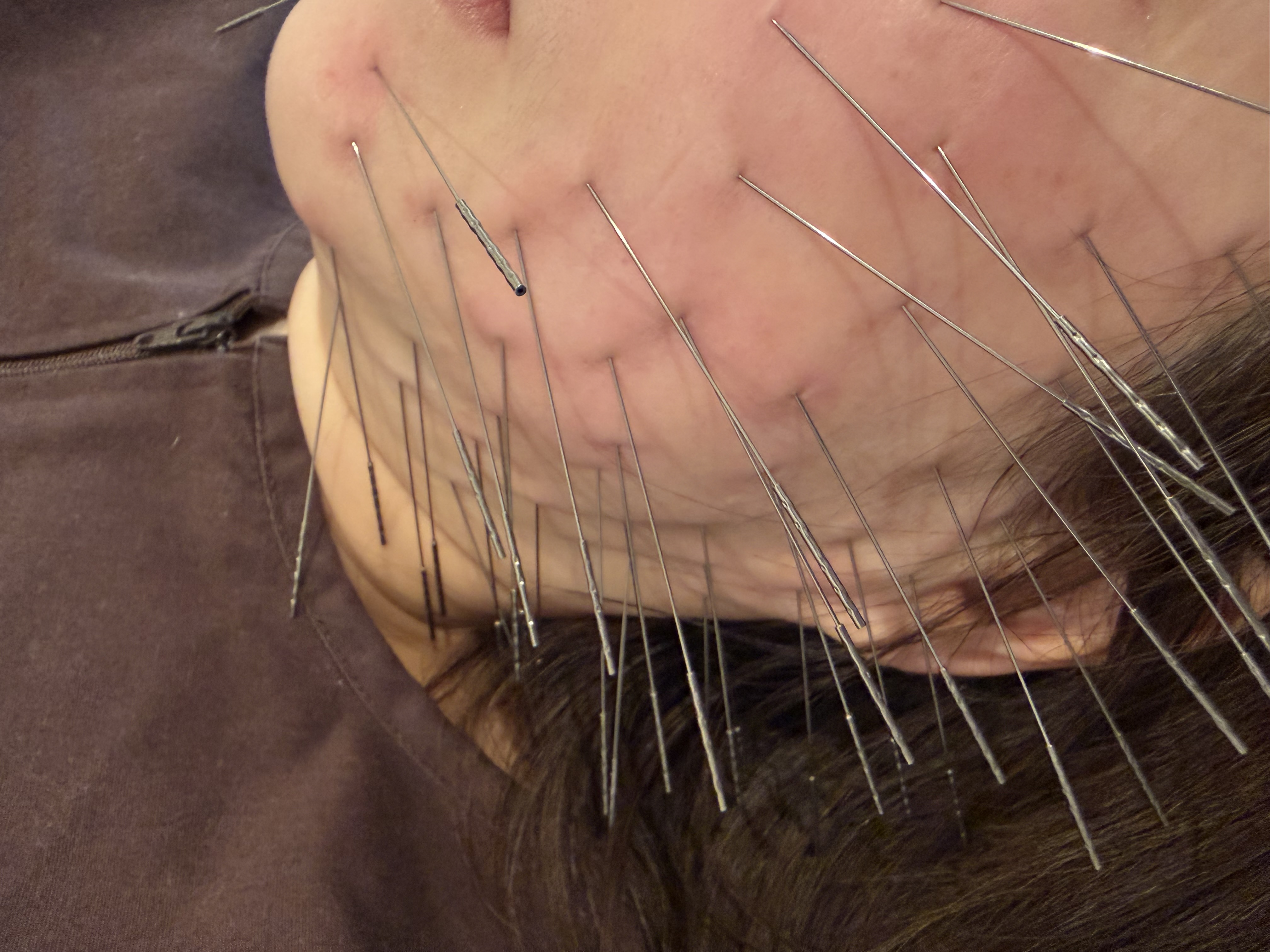 長﨑鍼療院【ルート治療認定院】 ルート鬼美容鍼(ショート)のメニュー画像