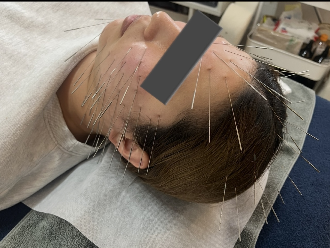 鍼灸salon　 ASENS   ルート治療院 美容鍼ショートのメニュー画像