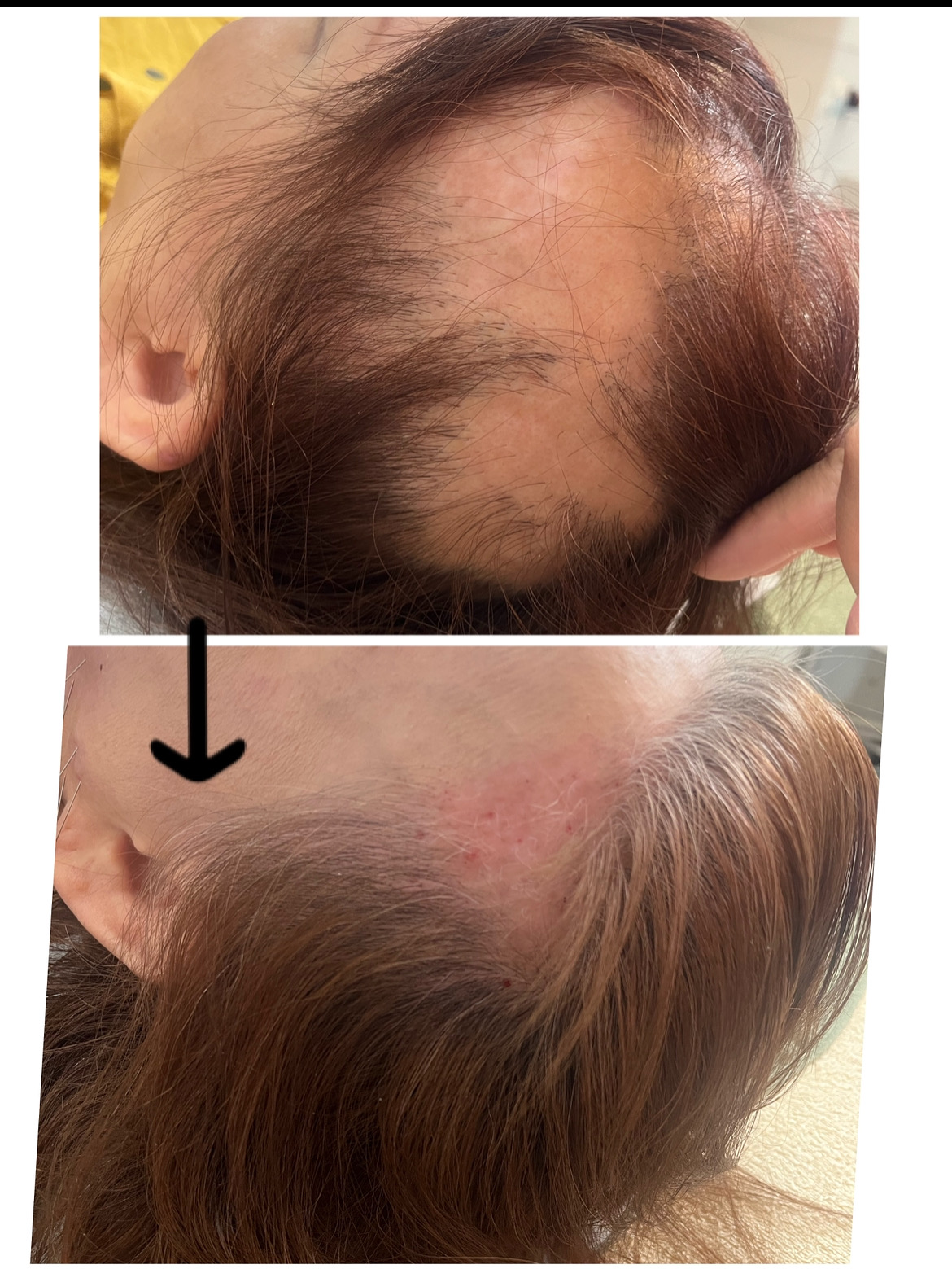 鍼灸salon　 ASENS   ルート治療院 育毛鍼ショートのメニュー画像